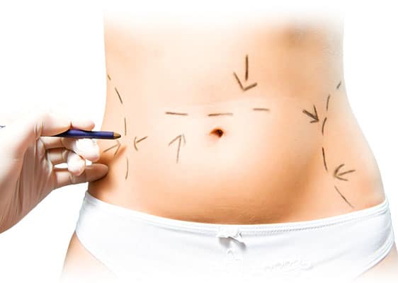 Lee más sobre el artículo ¿Cómo queda el abdomen después de una abdominoplastia?